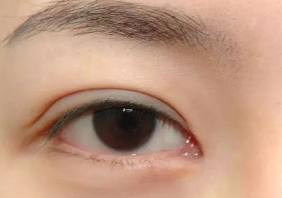 開(kāi)內(nèi)外眼角多久能恢復(fù)好？開(kāi)內(nèi)外眼角多少錢(qián)？