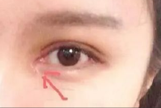 開(kāi)內(nèi)外眼角術(shù)后如何護(hù)理？