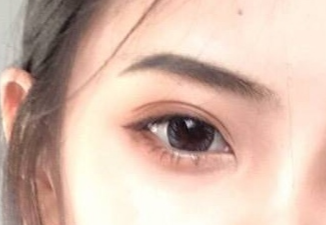 開(kāi)內(nèi)外眼角的恢復(fù)期是多久？