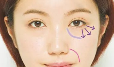 開(kāi)內(nèi)外眼角的效果如何？