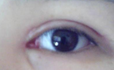 開外眼角拆線疼嗎？開內外眼角大概要多少錢？