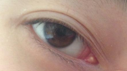 開(kāi)內(nèi)外眼角的方法有哪些？