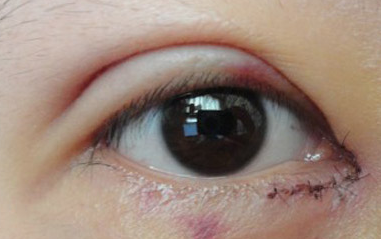 開內(nèi)眼角過程中會疼嗎？開內(nèi)眼角的風(fēng)險有哪些？