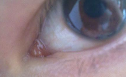 開內(nèi)外眼角需要注意什么？