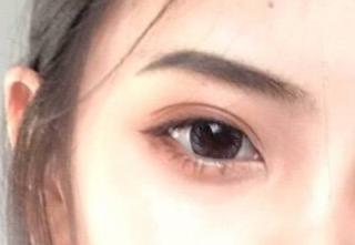 開內(nèi)外眼角有什么壞處？