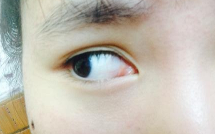 開(kāi)內(nèi)眼角多久可以回縮？開(kāi)內(nèi)眼角多久能消腫？