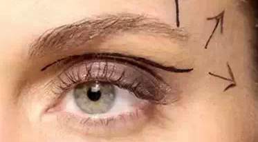 開內(nèi)外眼角需要幾次？