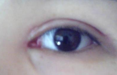 開內(nèi)外眼角效果怎么樣？