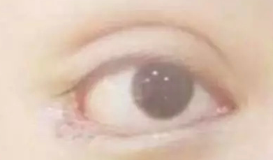 開內(nèi)眼角的效果好嗎？