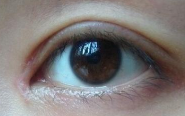 開內(nèi)眼角的禁忌癥是什么？
