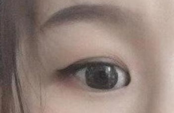 開(kāi)內(nèi)眼角的手術(shù)費(fèi)用多少？術(shù)后禁忌癥有哪些？