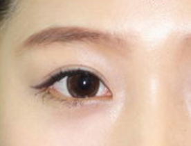 開(kāi)內(nèi)眼角安全嗎？