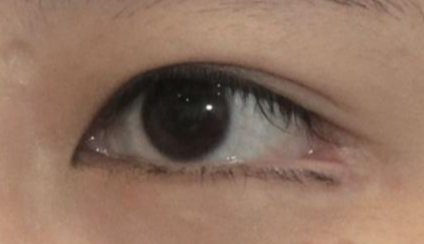 開眼角是永久的嗎？