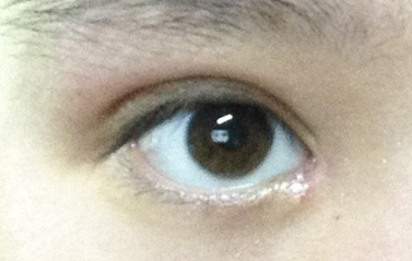 開眼角一定會(huì)出現(xiàn)疤痕嗎？