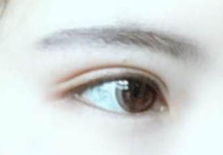 開(kāi)眼角有幾種方法?開(kāi)眼角有后遺癥嗎？