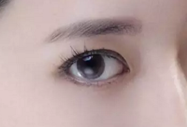 開(kāi)眼角術(shù)后多久才能恢復(fù)？開(kāi)眼角術(shù)后防止疤痕增生怎么做？