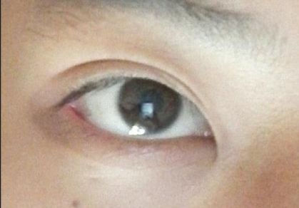 開(kāi)眼角手術(shù)后會(huì)影響視力嗎？開(kāi)眼角手術(shù)費(fèi)用貴嗎？