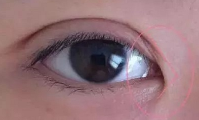 開(kāi)眼角手術(shù)價(jià)格要多少錢(qián)？