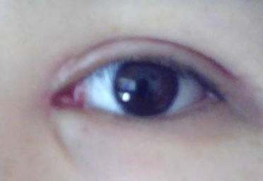 做一次開眼角多少錢？