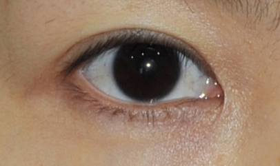 做完開眼角怎樣護(hù)理？