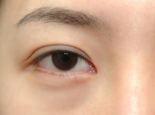 光纖溶脂去眼袋要多久消腫？術(shù)后如何護(hù)理？