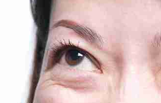 光纖溶脂祛眼袋好不好？