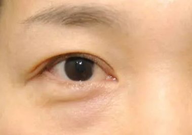 什么是埋線去眼袋？