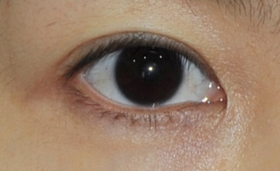 玻尿酸去眼袋安全有效嗎？