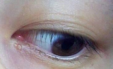 不開刀去眼袋多少錢？