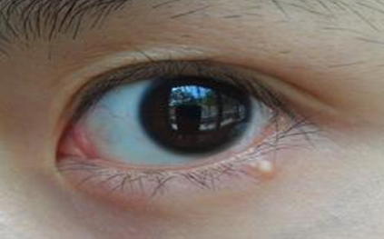 不開刀去眼袋安全嗎？不開刀去眼袋多少錢？