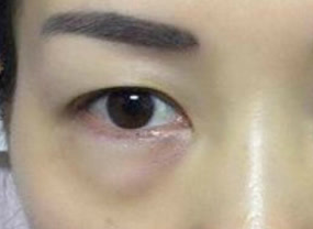 光纖溶脂去眼袋術(shù)后如何護(hù)理？