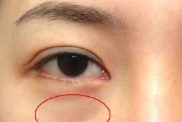 光纖溶脂祛眼袋怎么樣？