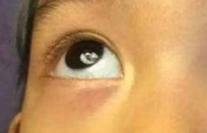 激光祛眼袋需要多少錢？