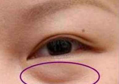 激光去眼袋有什么好處？激光祛眼袋有用嗎？