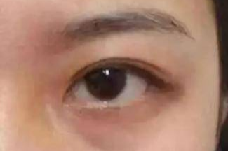 激光祛眼袋有哪些副作用？