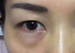 激光可以祛眼袋嗎？