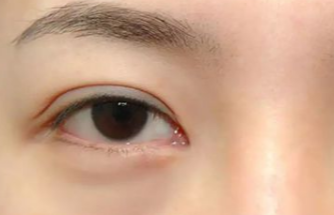 激光去眼袋多久做一次？激光去除眼袋后遺癥有哪些？