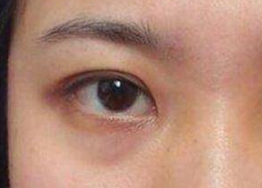 去眼袋是激光好還是內(nèi)切好？激光祛眼袋是什么原理？