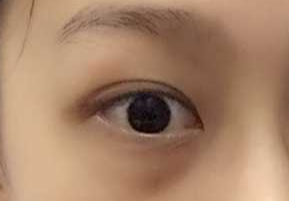 激光祛眼袋要多少錢？