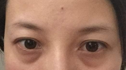 激光祛除眼袋有效嗎？