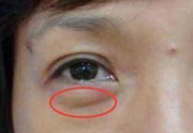 激光去眼袋可以管多久？激光祛眼袋多久可以恢復(fù)？