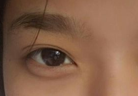 激光去眼袋后需多久能恢復(fù)？激光去眼袋快速有效嗎？