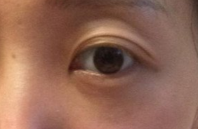 激光去眼袋要注意什么？