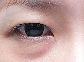 激光去眼袋的方法效果好嗎？激光去眼袋有什么壞處？