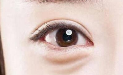 激光能祛除眼袋嗎？激光去眼袋有害處嗎？