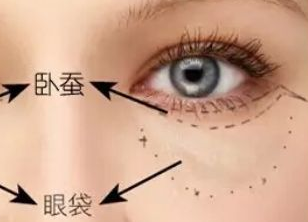 激光去眼袋多久才能恢復(fù)？激光去眼袋有什么副作用嗎？