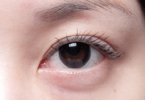 激光去眼袋會(huì)不會(huì)很疼？