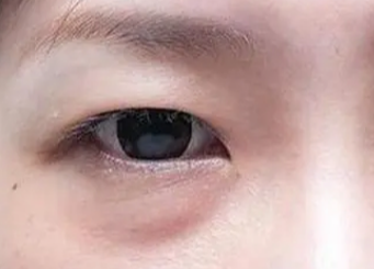 激光去眼袋要多長時(shí)間？做激光去眼袋手術(shù)要多久？