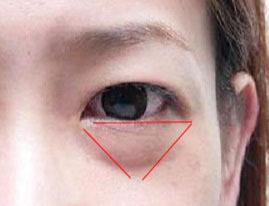 激光除眼袋效果如何？激光去眼袋要注意什么？