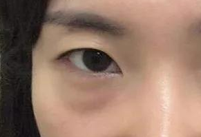 激光祛眼袋會疼嗎？激光去眼袋手術好嗎？